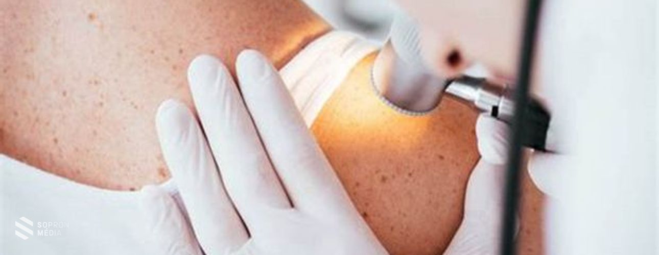 Három lépéssel a melanoma ellen