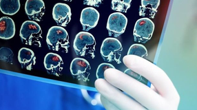 Stroke: minden perc számít!