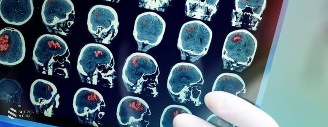 Stroke: minden perc számít!
